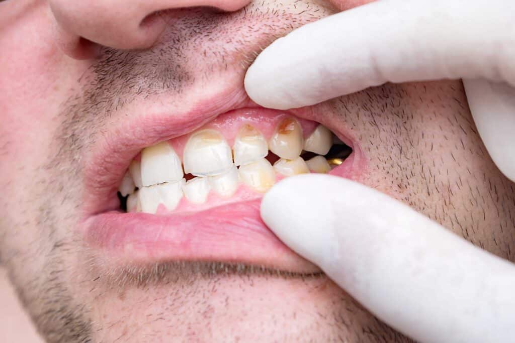 Emergency dental decay tooth